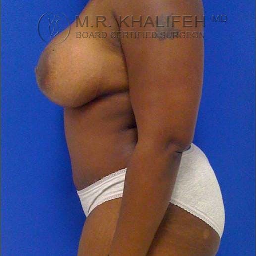 Tummy Tuck Gallery - Patient 3762078 - Image 4