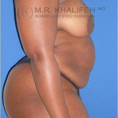 Tummy Tuck Gallery - Patient 3762078 - Image 5
