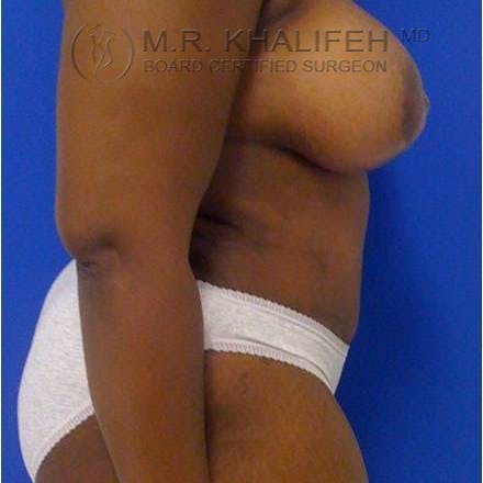 Tummy Tuck Gallery - Patient 3762078 - Image 6