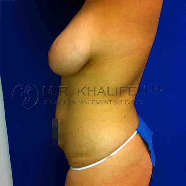 Breast Lift Gallery - Patient 3762079 - Image 3