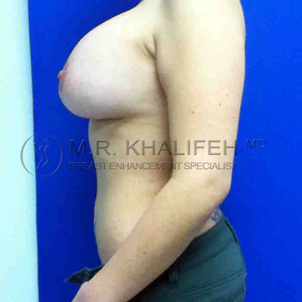 Breast Lift Gallery - Patient 3762079 - Image 4