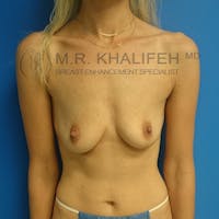 Breast Augmentation Gallery - Patient 3762081 - Image 1