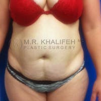 Tummy Tuck Gallery - Patient 3762080 - Image 1