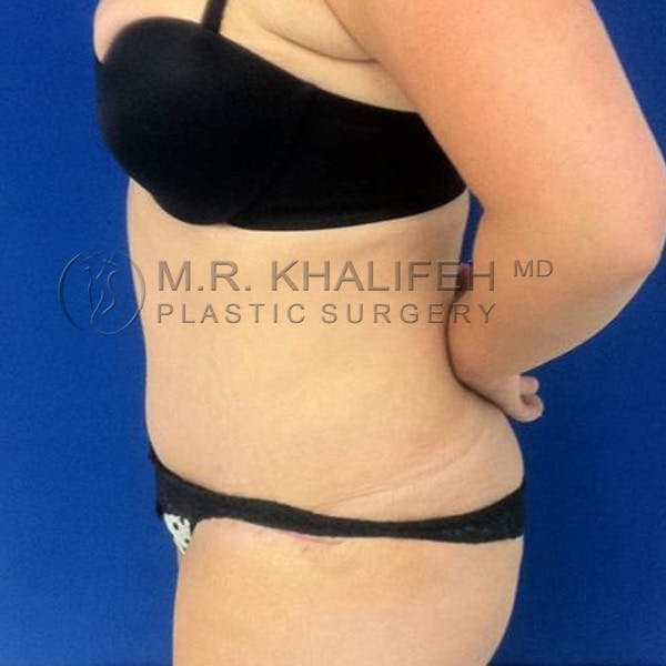Tummy Tuck Gallery - Patient 3762080 - Image 4