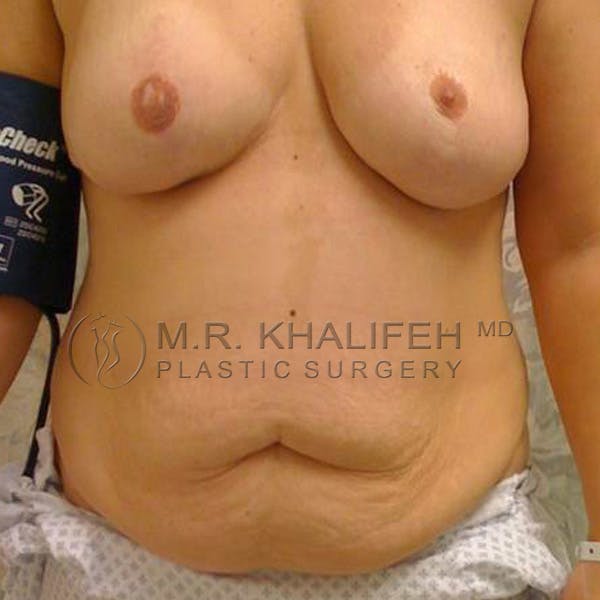 Tummy Tuck Gallery - Patient 3762083 - Image 1