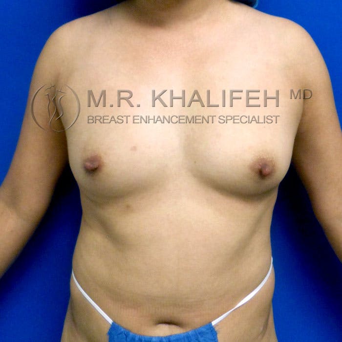 Breast Augmentation Gallery - Patient 3762091 - Image 1