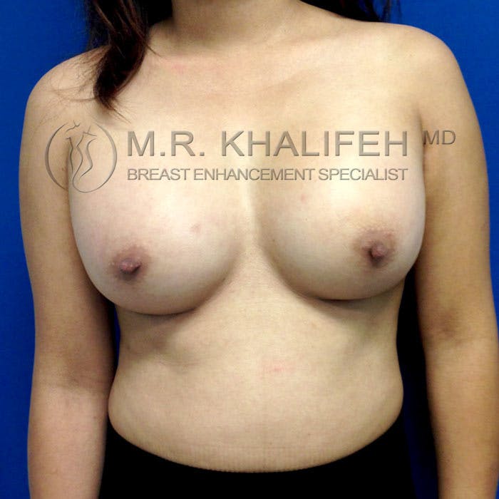 Breast Augmentation Gallery - Patient 3762091 - Image 2