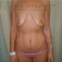 Tummy Tuck Gallery - Patient 3762092 - Image 1