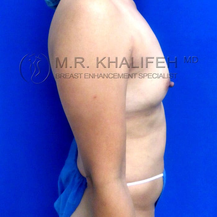 Breast Augmentation Gallery - Patient 3762091 - Image 5