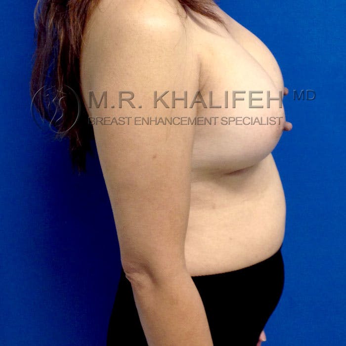 Breast Augmentation Gallery - Patient 3762091 - Image 6