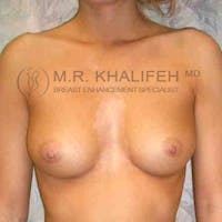 Breast Augmentation Gallery - Patient 3762115 - Image 1