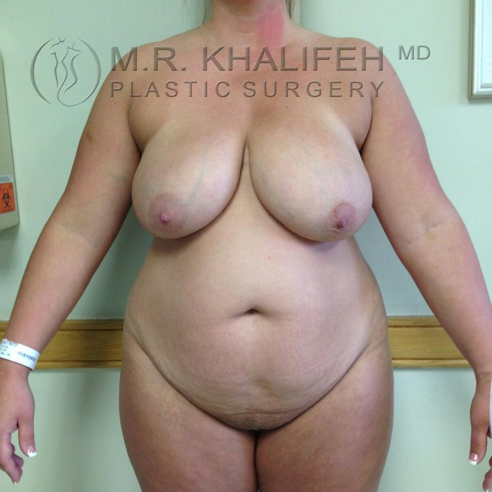 Tummy Tuck Gallery - Patient 3762120 - Image 1