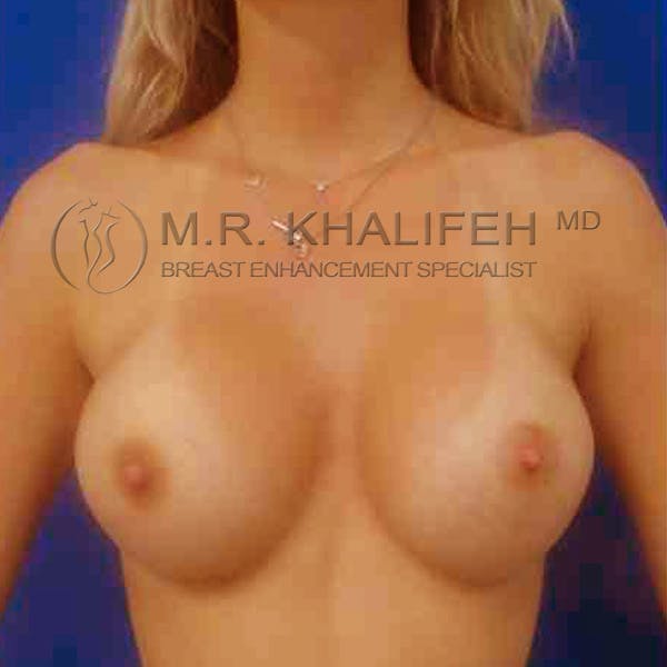 Breast Augmentation Gallery - Patient 3762115 - Image 2