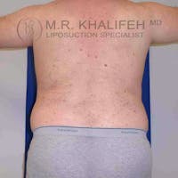 Male Liposuction Gallery - Patient 3762118 - Image 1