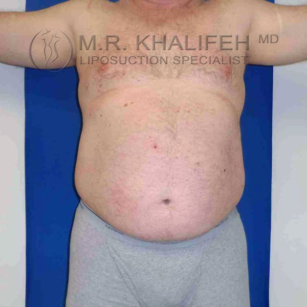Male Liposuction Gallery - Patient 3762118 - Image 3