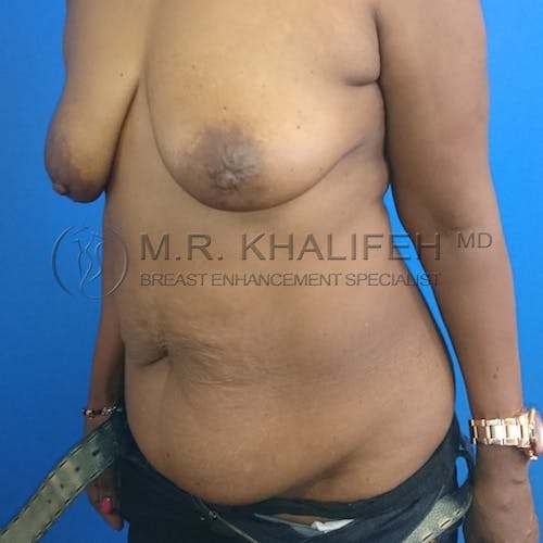 Breast Lift Gallery - Patient 3762119 - Image 3