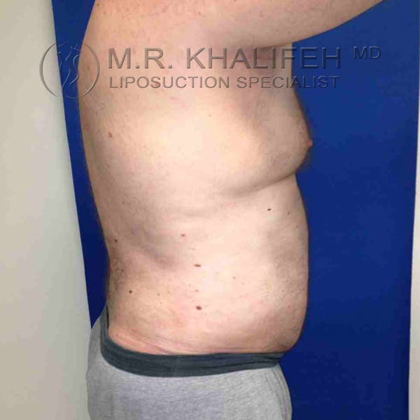 Male Liposuction Gallery - Patient 3762118 - Image 6
