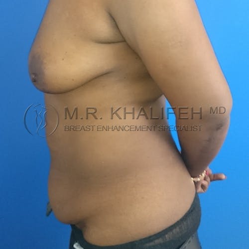 Breast Lift Gallery - Patient 3762119 - Image 5
