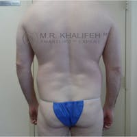 Male Liposuction Gallery - Patient 3762130 - Image 1
