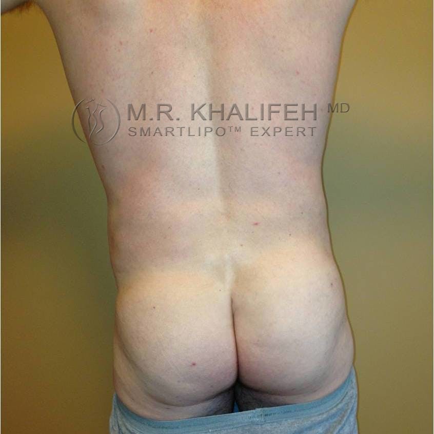 Male Liposuction Gallery - Patient 3762130 - Image 2
