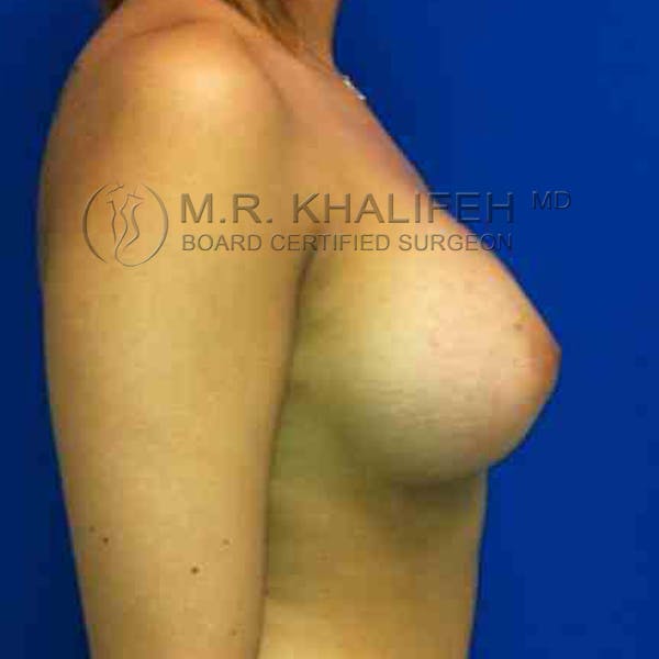 Breast Augmentation Gallery - Patient 3762122 - Image 6