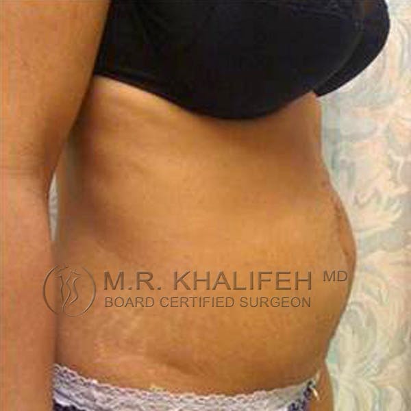 Tummy Tuck Gallery - Patient 3762129 - Image 3