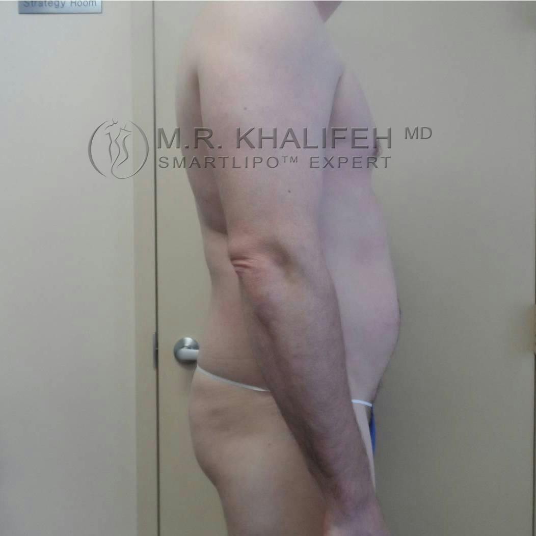 Male Liposuction Gallery - Patient 3762130 - Image 3