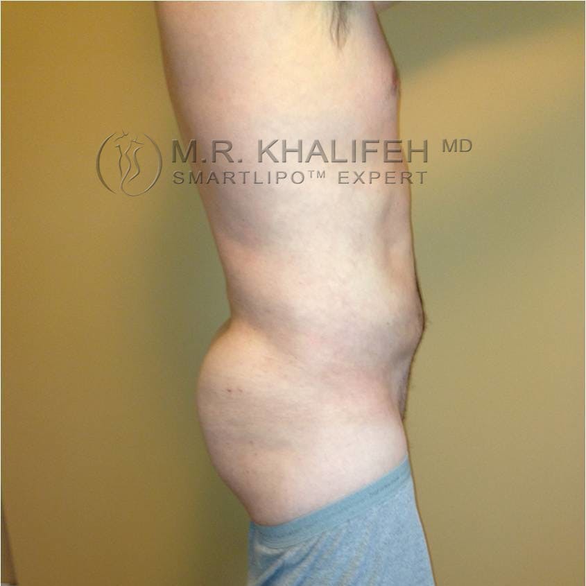 Male Liposuction Gallery - Patient 3762130 - Image 4