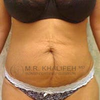 Tummy Tuck Gallery - Patient 3762129 - Image 1