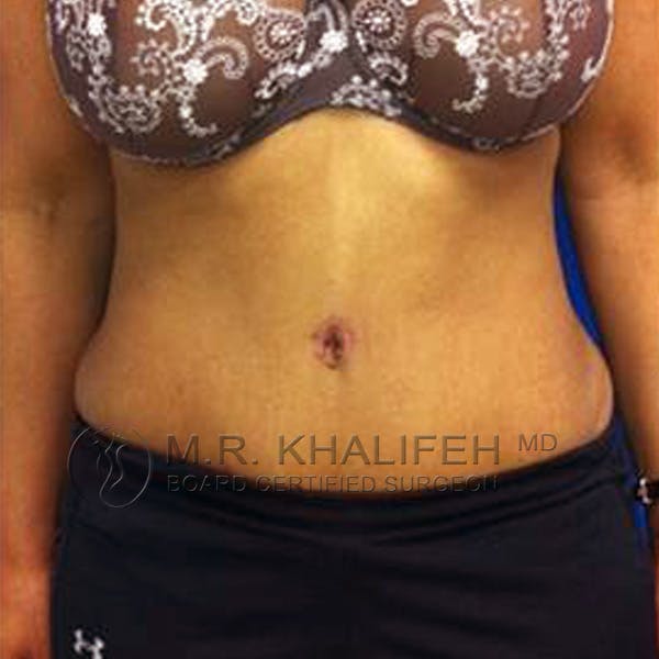 Tummy Tuck Gallery - Patient 3762129 - Image 2