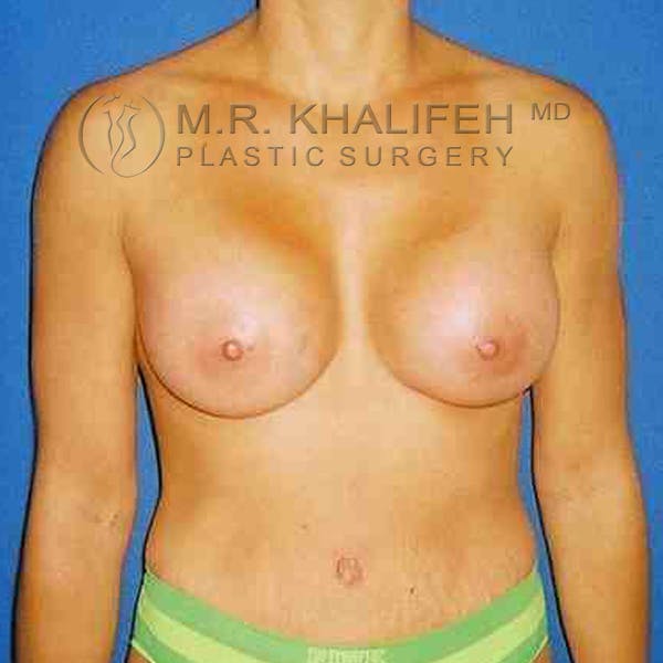 Breast Augmentation Gallery - Patient 3762132 - Image 2