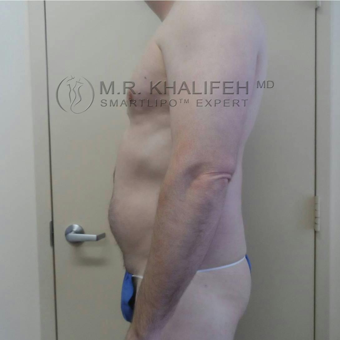 Male Liposuction Gallery - Patient 3762130 - Image 7