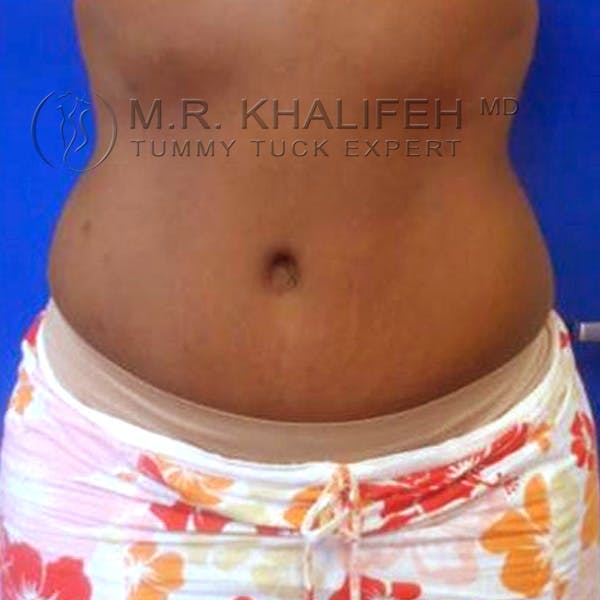 Tummy Tuck Gallery - Patient 3762135 - Image 2