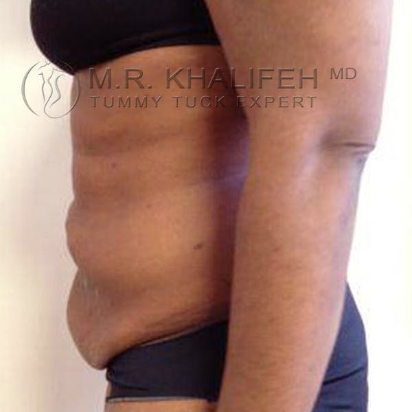 Tummy Tuck Gallery - Patient 3762135 - Image 3