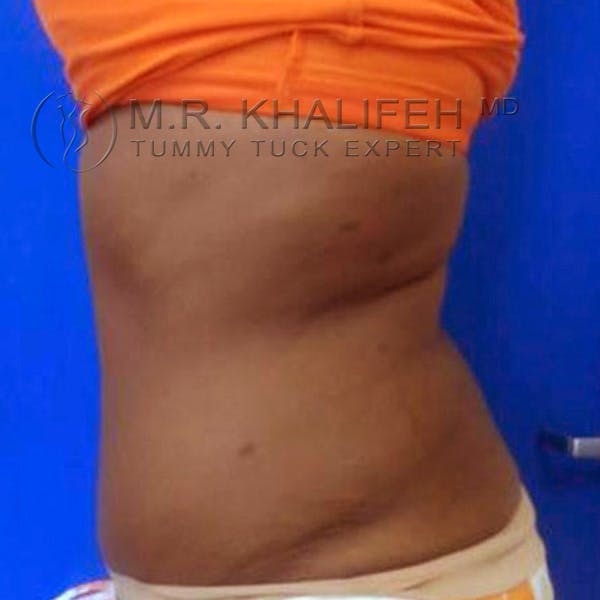 Tummy Tuck Gallery - Patient 3762135 - Image 4