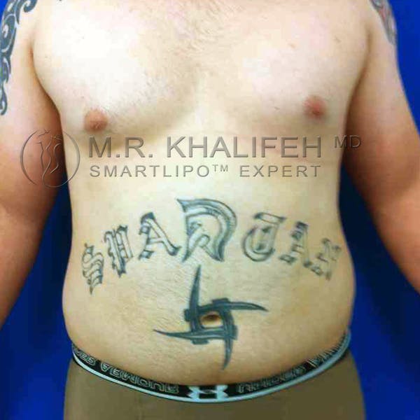 Male Liposuction Gallery - Patient 3762144 - Image 3