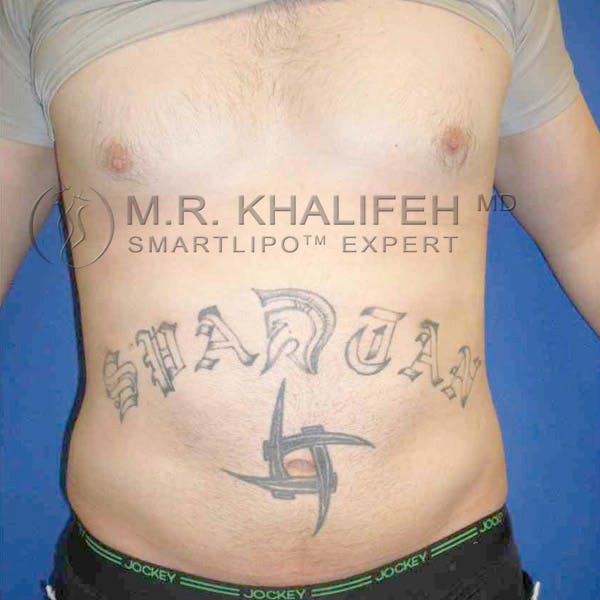 Male Liposuction Gallery - Patient 3762144 - Image 4
