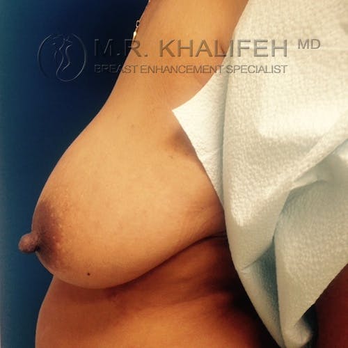 Breast Lift Gallery - Patient 3762148 - Image 3
