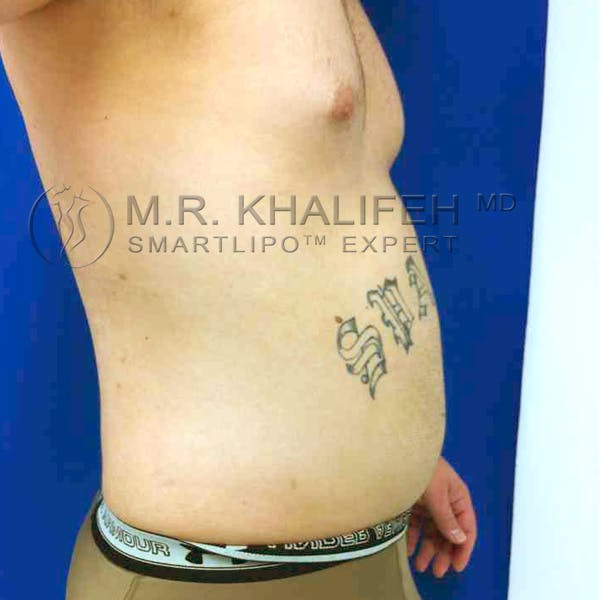 Male Liposuction Gallery - Patient 3762144 - Image 5