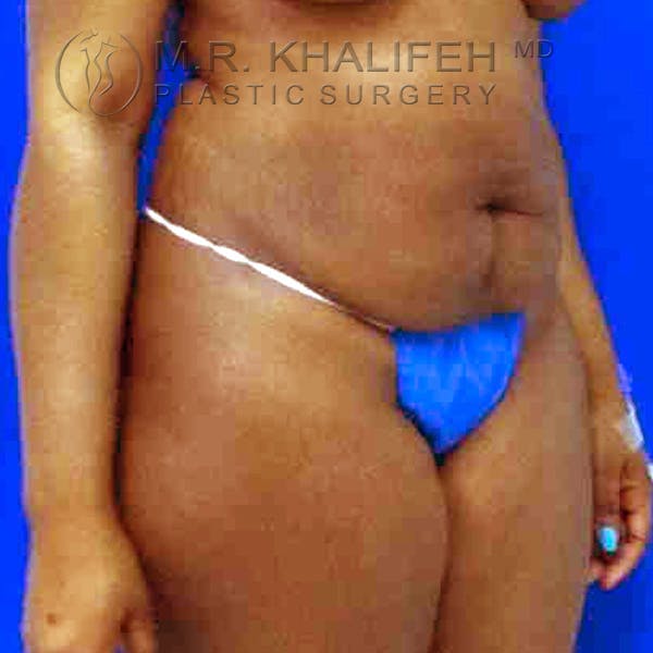 Tummy Tuck Gallery - Patient 3762152 - Image 1