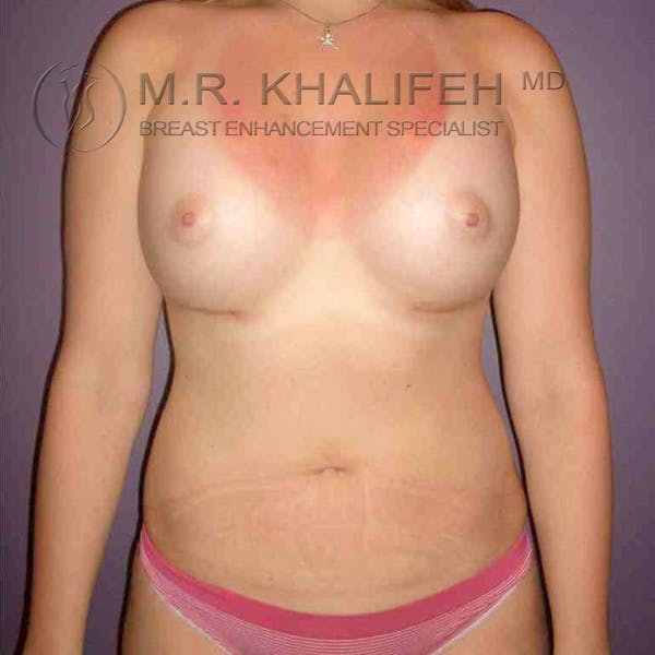 Breast Augmentation Gallery - Patient 3762147 - Image 4