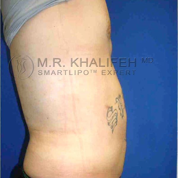 Male Liposuction Gallery - Patient 3762144 - Image 6