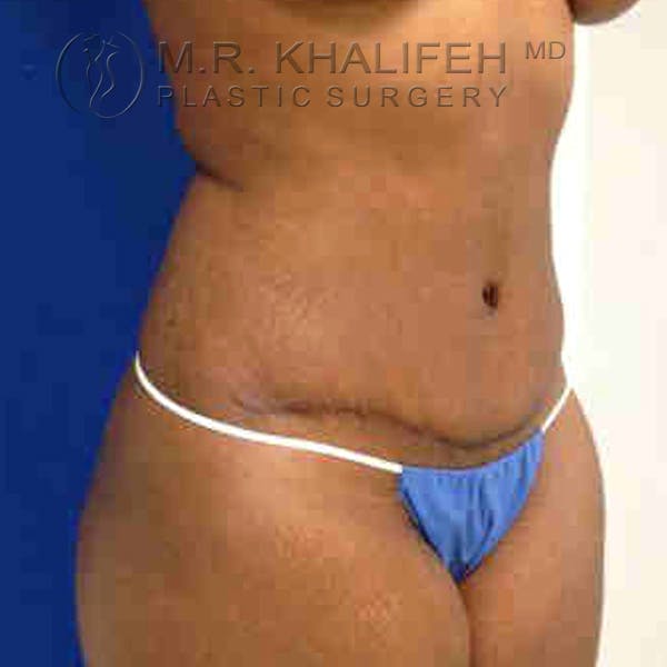 Tummy Tuck Gallery - Patient 3762152 - Image 2
