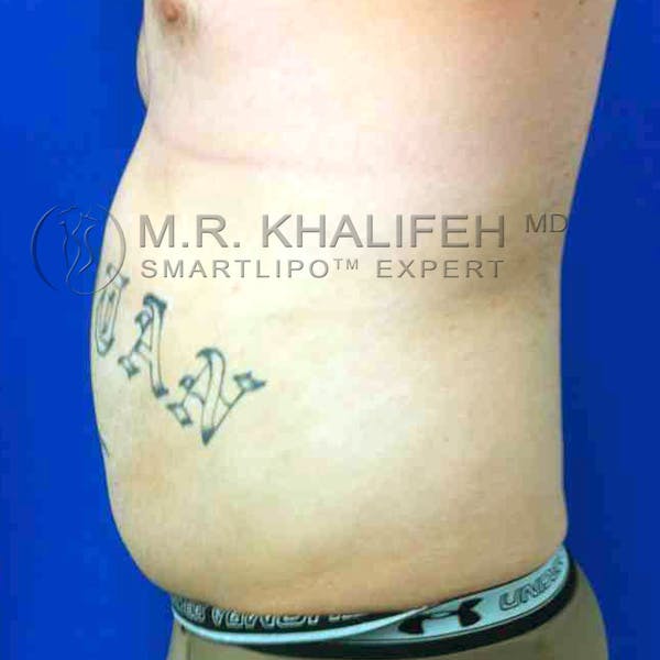 Male Liposuction Gallery - Patient 3762144 - Image 7