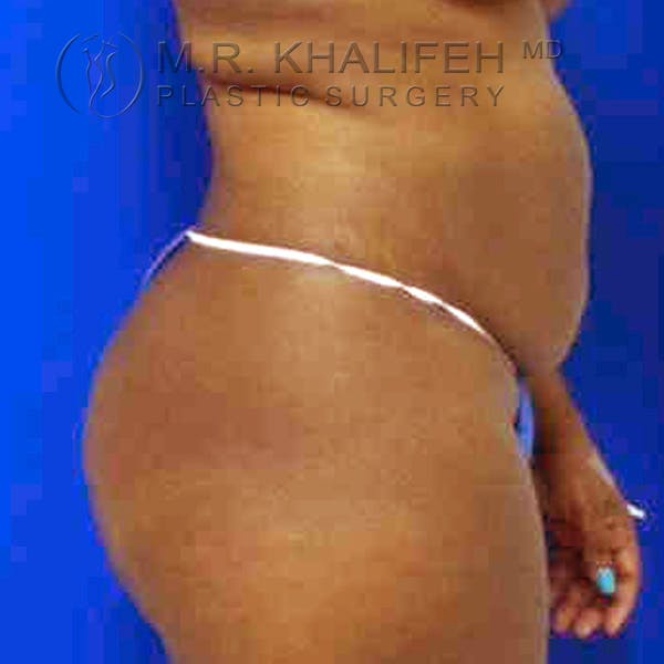 Tummy Tuck Gallery - Patient 3762152 - Image 3