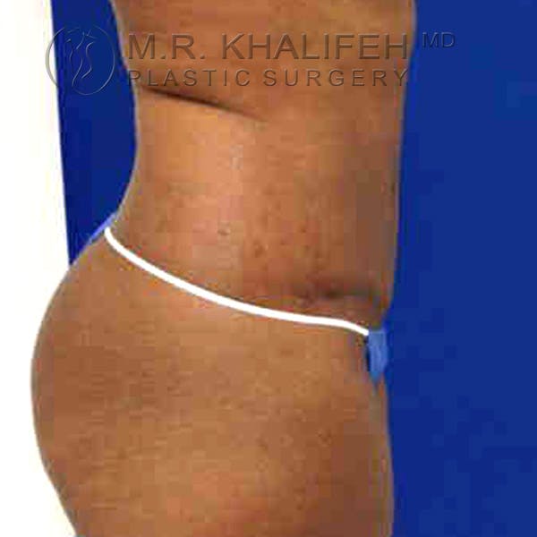 Tummy Tuck Gallery - Patient 3762152 - Image 6