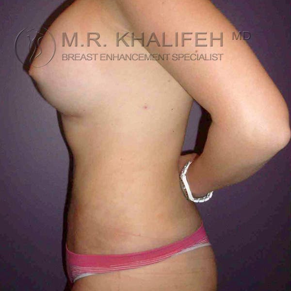 Breast Augmentation Gallery - Patient 3762147 - Image 6