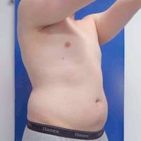Male Liposuction Gallery - Patient 3762159 - Image 1