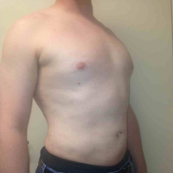 Male Liposuction Gallery - Patient 3762159 - Image 2