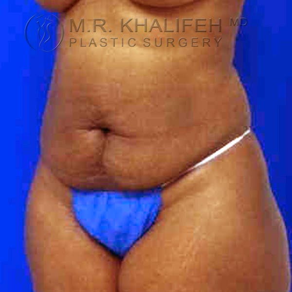 Tummy Tuck Gallery - Patient 3762152 - Image 9